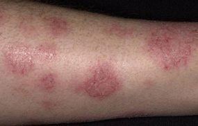 Bệnh chàm (Eczema): Triệu chứng nhận biết và cách điều trị