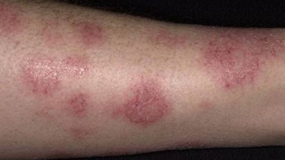 Bệnh chàm (Eczema): Triệu chứng nhận biết và cách điều trị