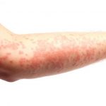 Dị ứng cơ địa là gì?