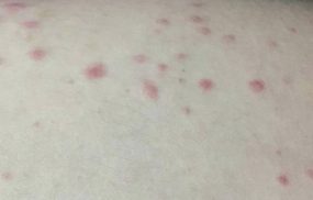 Nổi chấm đỏ trên da như nốt ruồi son là bị gì? Có nguy hiểm?