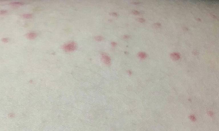 Nổi chấm đỏ trên da như nốt ruồi son là bệnh gì