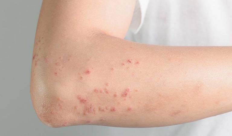 Nổi mẩn ngứa ở khuỷu tay, đầu gối nguy hiểm không?