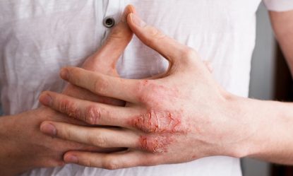 Bệnh viêm da tiếp xúc: Nguyên nhân, Triệu chứng, Cách điều trị