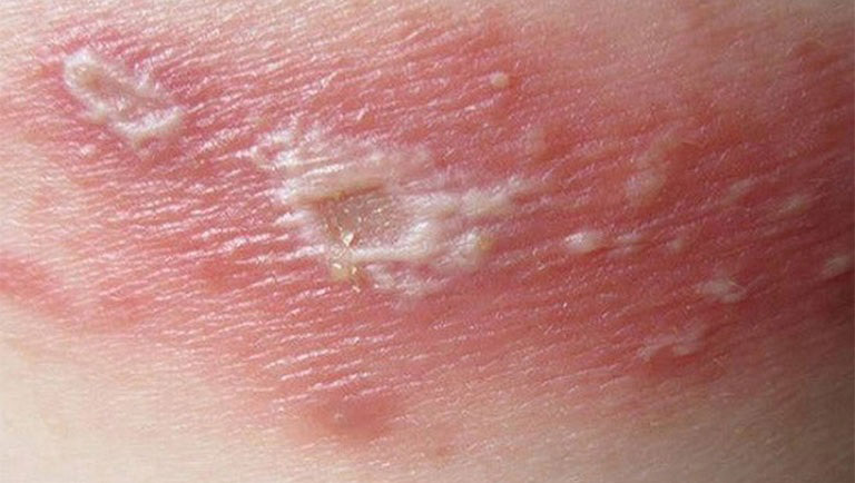 viêm da tiếp xúc bội nhiễm là gì