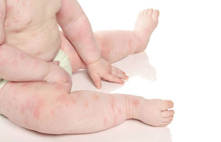 Bé bị nổi mẩn đỏ từng mảng là bệnh gì? Nguy hiểm không?