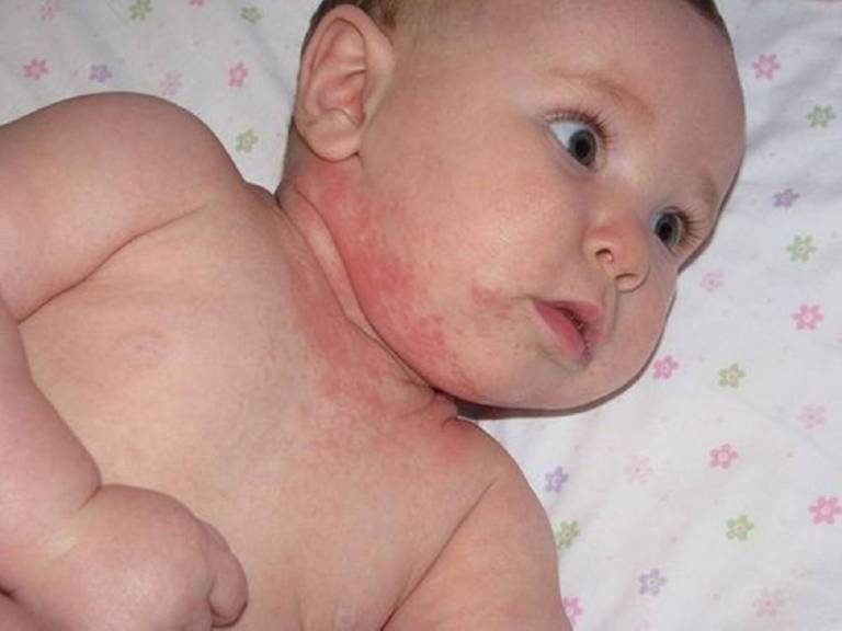 Bệnh viêm da tiếp xúc gây nổi mẩn đỏ từng mảng ở bé