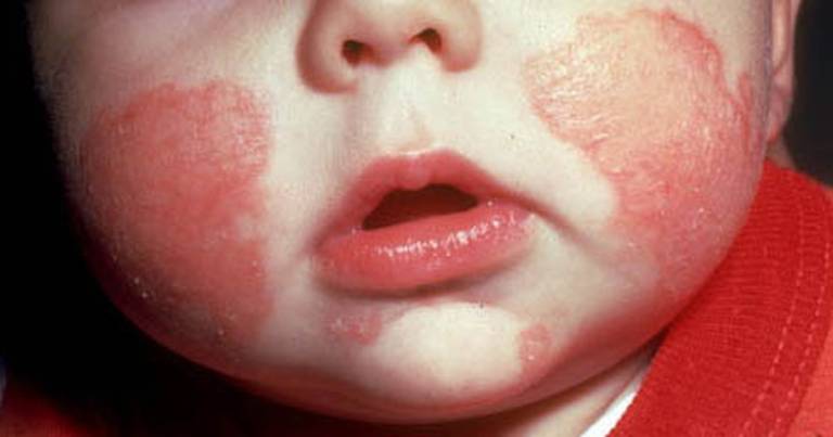 Bệnh Eczema ở trẻ em - Nguyên nhân và hướng điều trị