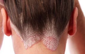 Bệnh vảy nến da đầu: Thuốc và cách trị hiệu quả