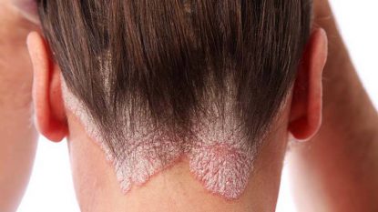 Bệnh vảy nến da đầu: Thuốc và cách trị hiệu quả