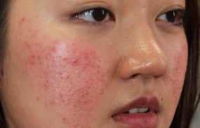 Da mặt bị dị ứng nổi sẩn ngứa có nguy hiểm không?
