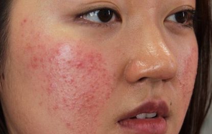 Da mặt bị dị ứng nổi sẩn ngứa có nguy hiểm không?