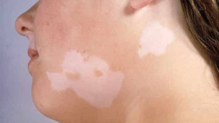 Da nổi đốm trắng không ngứa: Nguyên nhân và cách chữa