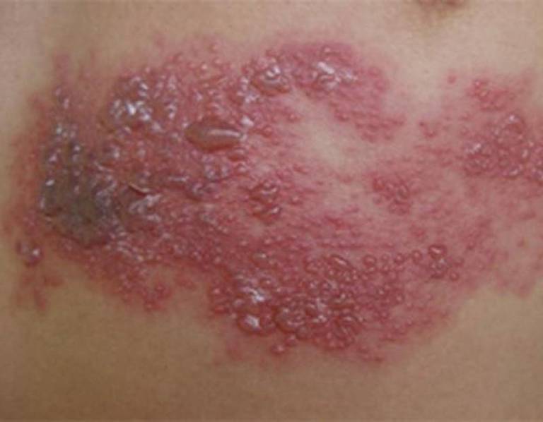 Hình ảnh kiến ba khoang đốt gây viêm da