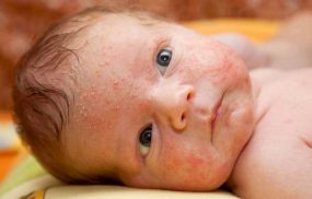 Viêm da tiếp xúc ở trẻ em: Cách điều trị và phòng ngừa