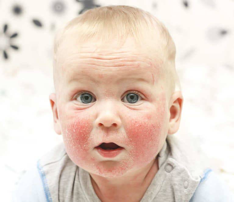 Viêm da tiếp xúc ở trẻ em và dấu hiệu nhận biết