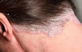 Bệnh á sừng da đầu là gì?