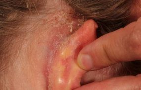 Bệnh chàm tai: Nguyên nhân gây bệnh và cách điều trị