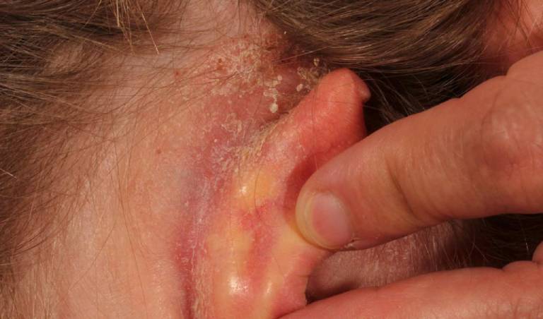 Bệnh chàm tai: Nguyên nhân gây bệnh và cách điều trị