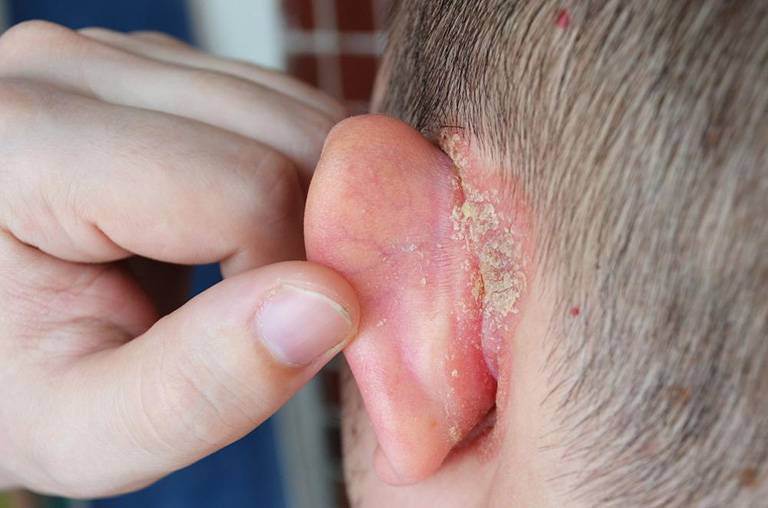 Biểu hiện nhận biết bệnh chàm tai