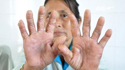 Cách chữa bệnh á sừng ở đầu ngón tay, bàn tay hiệu quả