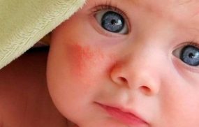 Chàm đỏ ở trẻ sơ sinh - Hướng dẫn chăm sóc điều trị đúng cách