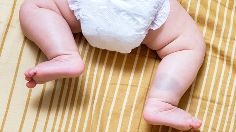 Vết chàm xanh ở trẻ sơ sinh có tự hết không?
