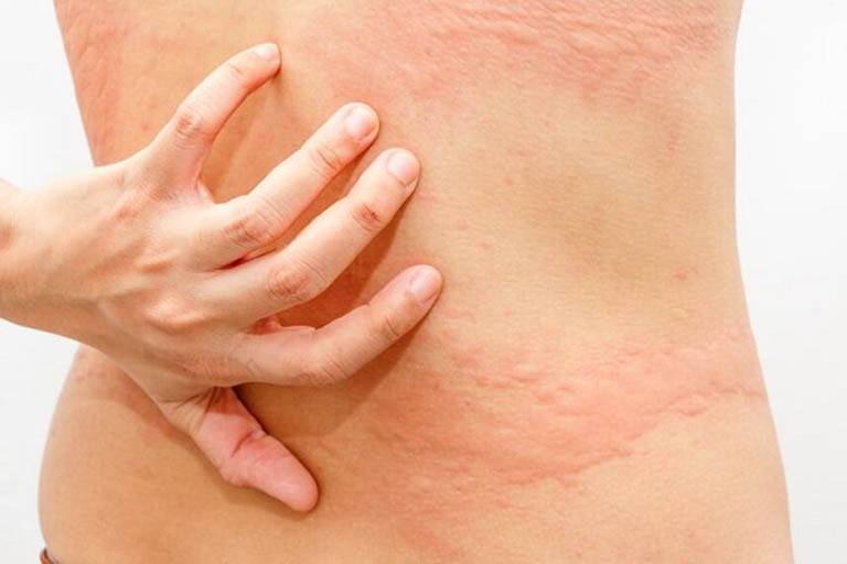 Nổi mẩn ngứa vùng thắt lưng cần cảnh giác những bệnh này