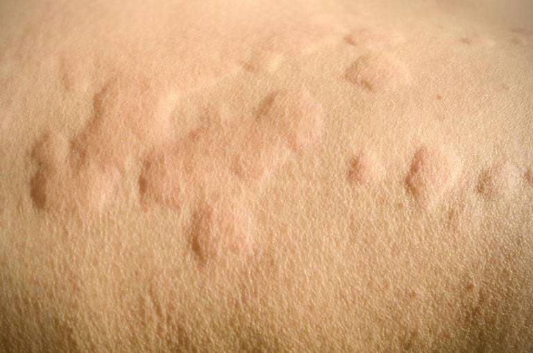 Bệnh viêm da dị ứng