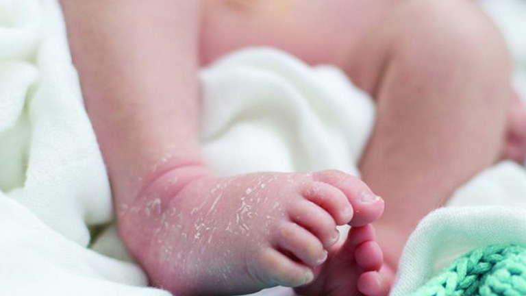 Vùng da bị khô da ở trẻ sơ sinh