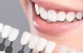 Top 5 địa chỉ dán sứ veneer phục hình răng uy tín tại TPHCM
