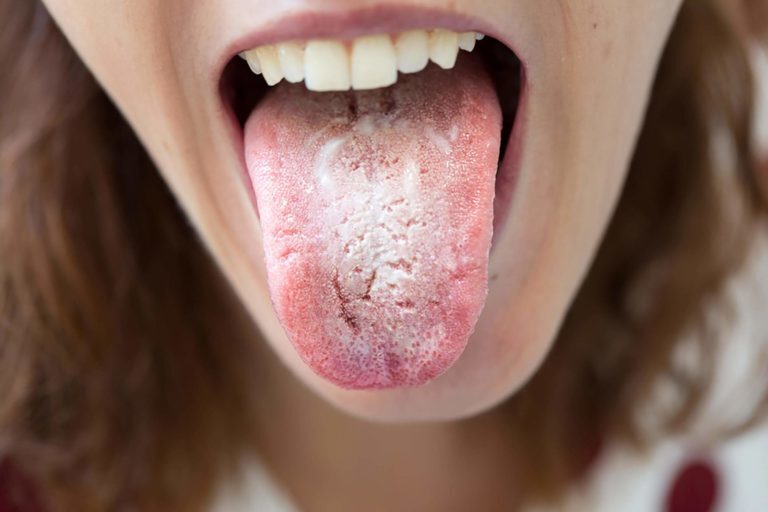 Những cách phòng ngừa bệnh lưỡi trắng đau họng