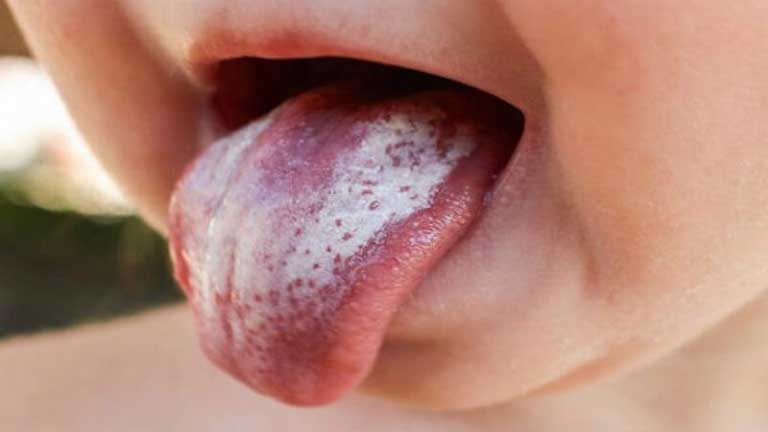 Bị lưỡi trắng đau họng khi nào cần khám bác sĩ?