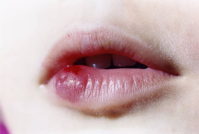 Xưng môi có thể là tác dụng phụ của thuốc Finasteride