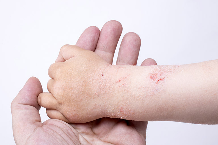Vai trò của việc dưỡng ẩm đối với trẻ em bị viêm da cơ địa