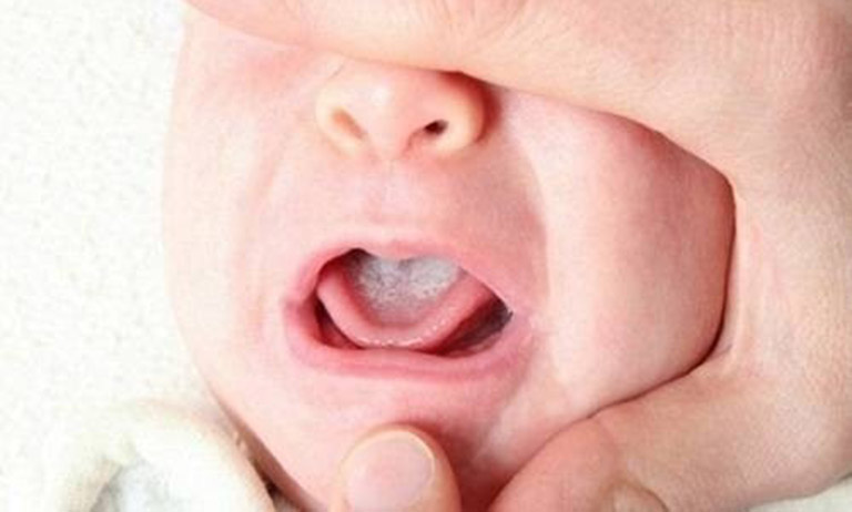 Chẩn đoán nấm miệng cho trẻ