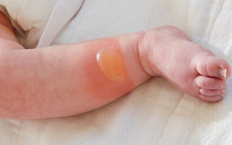 Trẻ sơ sinh bị phồng rộp da