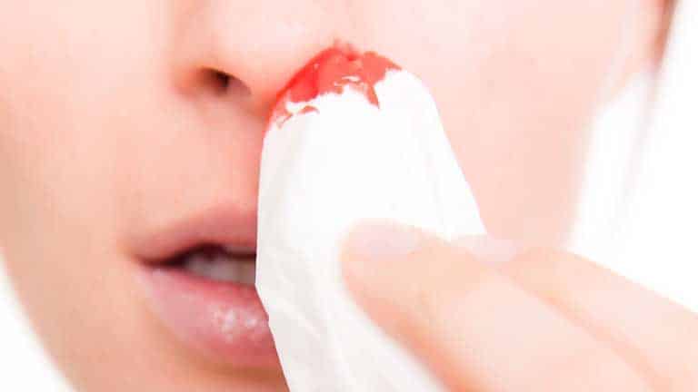 Viêm xoang chảy máu mũi là gì?