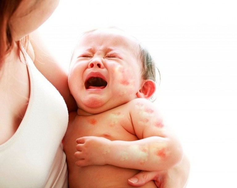 Bé tắm xong bị nổi mẩn đỏ là do đâu?