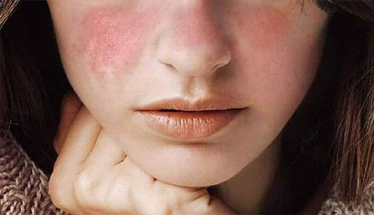 Da mặt bị đỏ và rát có nguy hiểm không?