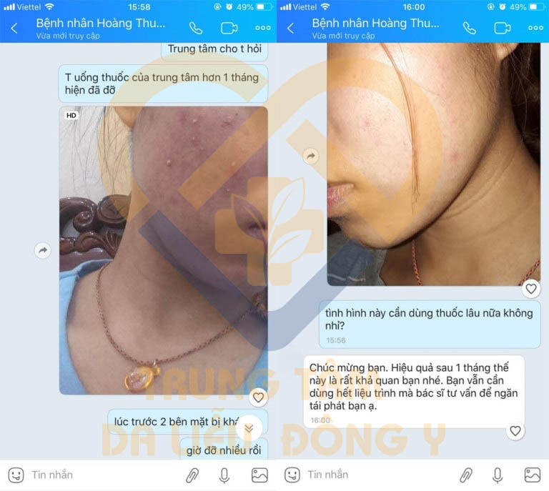 Dị ứng, mẩn ngứa đỏ rát da mặt cũng được cải thiện sau khi sử dụng bài thuốc
