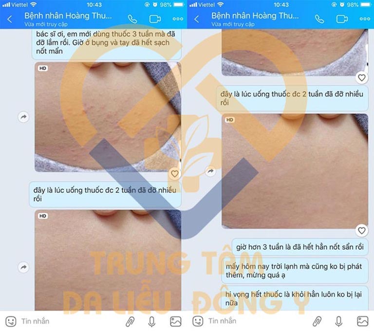 Bệnh nhân cho phản hồi tích cực trong quá trình sử dụng An Bì Thang chữa dị ứng mẩn ngứa
