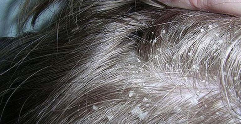 nấm da đầu