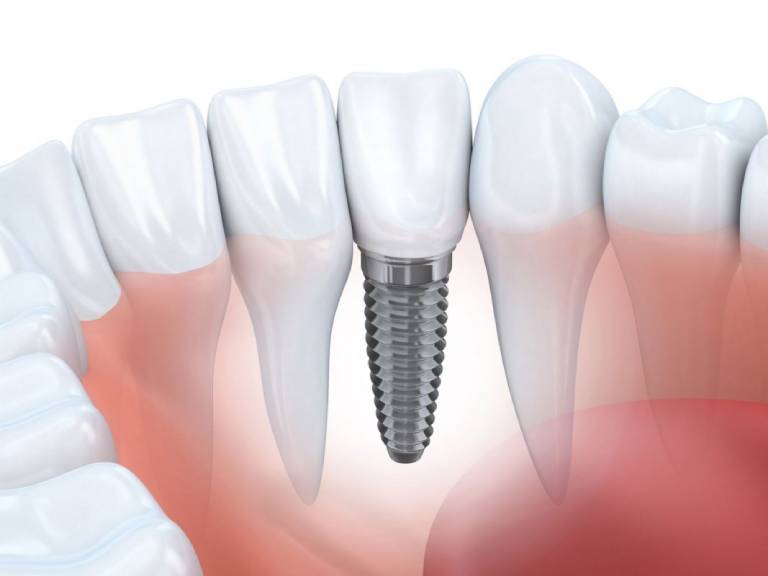 Top 10 địa chỉ Trồng răng, Cấy ghép Implant uy tín tại Hà Nội