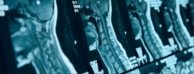 Một số hình ảnh thoát vị đĩa đệm được chụp cộng hưởng từ MRI
