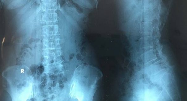 Chụp X Quang Có Phát Hiện Thoát Vị Đĩa Đệm Không? [Giải Đáp]