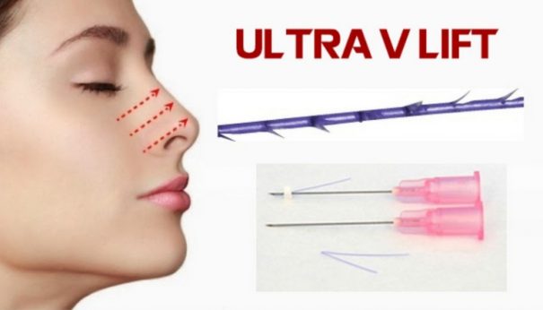 Nâng mũi bằng chỉ Ultra V Lift là gì?