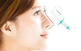 Nâng mũi chỉ: Phương pháp nâng mũi tiềm ẩn nhiều nguy hiểm