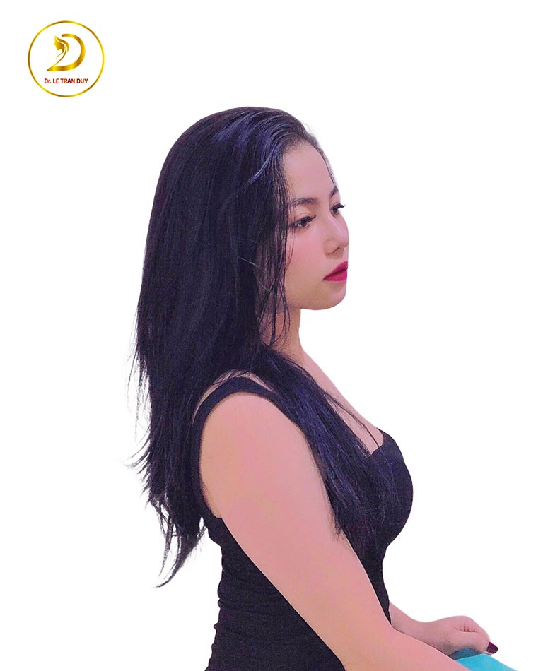 nâng mũi sline đẹp