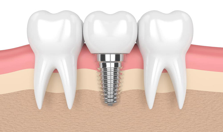 Top 5 Địa Chỉ Trồng Răng Implant Tại Đà Nẵng Có Bác Sĩ Giỏi Nhất