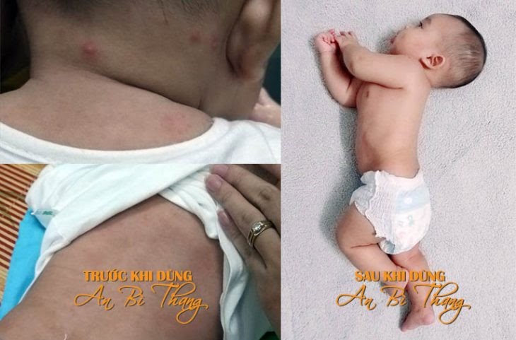 Bé Momo (4 tháng tuổi) - con chị Phạm Thanh Trà (29 tuổi, Nam Từ Liêm, Hà Nội) đã được điều trị khỏi bệnh mề đay mẩn ngứa bằng bài thuốc An Bì Thang